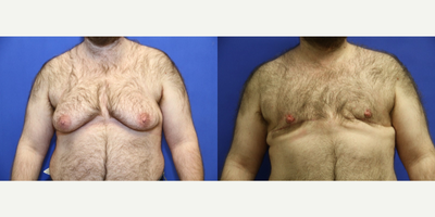 38 year old trans man treated with FTM Chest Masculinization Surgery - Preservation of enough fat and breast tissue is very important in the overweight patient to avoid a hollow, flat or scooped out appearance. Bulges or rolls of side fat may become more noticeable.