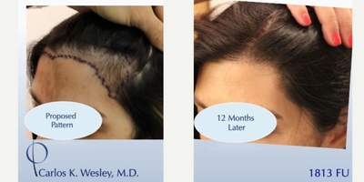 45-54 year old woman treated with Hair Transplant - This 51-year-old woman underwent a follicular unit transplantation(FUT) session with Dr. Carlos K. Wesley in which a total of 1813 grafts were placed. In addition, she had also benefited from daily use of our Follicle Advantage Nutritional Supplement, one of the more popular hair-growth products offered to our patients. Her hair follicles were incubated in autologous (her own) platelet rich plasma (PRP) throughout the duration of the procedure. This, combined with an ATP-containing storage solutionhas been shown to enhance survival of transplanted hairs[/URL].As with all of Dr. Wesleys patients, she was NOT required to shave her hair for the procedure. As a result, this patient was able to return comfortably to work and social activities within approximately 7-10 days of his procedure.