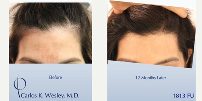 45-54 year old woman treated with Hair Transplant - This 51-year-old woman underwent a follicular unit transplantation(FUT) session with Dr. Carlos K. Wesley in which a total of 1813 grafts were placed. In addition, she had also benefited from daily use of our Follicle Advantage Nutritional Supplement, one of the more popular hair-growth products offered to our patients. Her hair follicles were incubated in autologous (her own) platelet rich plasma (PRP) throughout the duration of the procedure. This, combined with an ATP-containing storage solutionhas been shown to enhance survival of transplanted hairs[/URL].As with all of Dr. Wesleys patients, she was NOT required to shave her hair for the procedure. As a result, this patient was able to return comfortably to work and social activities within approximately 7-10 days of his procedure.