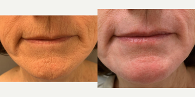 65-74 year old woman treated with Laser Resurfacing - One treatment of TRL laser around the mouth (peri-oral) in our office.