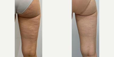 Woman treated with Emtone - Woman treated with Emtone