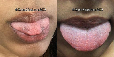 25-34 year old woman treated with Laser Peel - 26 year old woman treated with 1 RUby laser treatment for tongue pigmentation