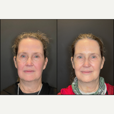 55-64 year old woman treated with BroadBand Light (BBL), Botox for Hyperhidrosis - 1 Month Post Forever Young BBL to Target Redness