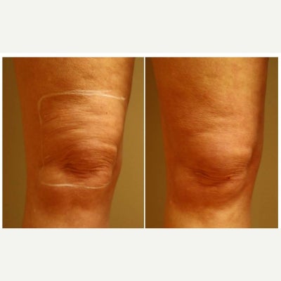 45-54 year old woman treated with Halo Laser - Pt. had a single Halo laser treatment to the wrinkled skin above the knee