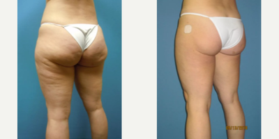 Woman treated with Liposuction - Liposuction - Inner and/or Outer Thighs.This patient came in because she had been concerned with a few deep dimples on her legs, as well as her tendency to gain weight in her thighs. She decided to do Smart Lipo on her inner and outer thighs, and in combination get the Profound treatment on the front of her thighs. The doctoralso did some extra work to release the fibers on the sides of her legs to create a much smoother appearance.