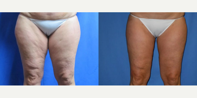 Woman treated with Liposuction - 35 year old female had Smart Lipo from the doctoron her inner and outer thighs. She had a great reduction in the circumference of her thigh measurement, she lost 10 inches! She went from a size 16 pants to a size 12.
