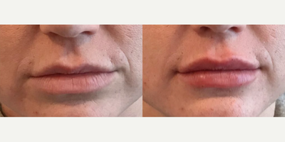 Woman treated with Lip Fillers, Dermal Fillers - Gorgeous natural lips done by Dr. M.