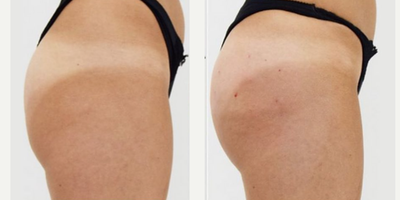 Woman treated with Sculptra, Nonsurgical Butt Lift - Sculptra Butt-Lift by Dr. Marciano!