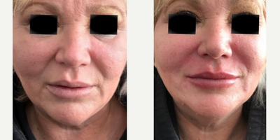 Woman treated with Dermal Fillers - This beautiful patient wanted fuller lips and erase her marionette lines. Spring is around the corner! Look and feel younger in minutes with no down-time!