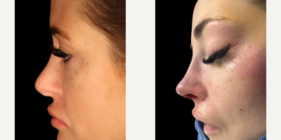 Revision Rhinoplasty Finesse - This patient came to me after having an unsuccessful rhinoplasty in town. She was left with a pollybeak deformity (excess supratip tissue), alar retraction, twisted tip and excess columellar show. She had no cartilage remaining in her septum, so I performed rib harvest to obtain the cartilage needed for structural support. Here she is on the table, with much more definition, narrowed and straightened nasal bones, and elimination of alar retraction.