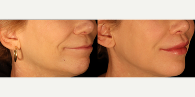 Deep Plane Lip Lift - Above is an excellent example of the rejuvenating power of a surgical lip lift. No filler/fat was used in the lips!As we age -- and particularly if we get lip filler -- the skin of the upper lip lengthens. This creates facial imbalance and deflates upper lip volume.This wonderful patient is 4 weeks out from a deep lip lift. Her new pout is effortless, and does not look overdone or plastic. This is a procedure that can be performed under local anesthesia in the office or combined with other procedures in the OR.Note the incision travels around the base of the nose and is hidden in a natural crease. You can see the inconspicuous line of the incision in this photo, and this will continue to fade with time.