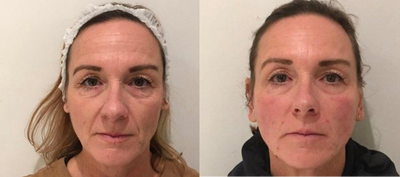 45-54 year old woman treated with Silhouette Soft - 10 8 Cone Sutures were placed to lift and contour the cheek and define the jaw line. There is an immediate improvement in nasolabial fold and cheek sagging and the results will continue to improve over the next 3 monthsThe after image was taken immediately on completion of the procedure. River Aesthetics doctors are global trainers for this procedure and the clinic is a centre of excellence for thread lifting