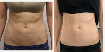 35-44 year old woman treated with Evolve - 35-44 year old woman treated with Evolve for skin laxity of abdomen