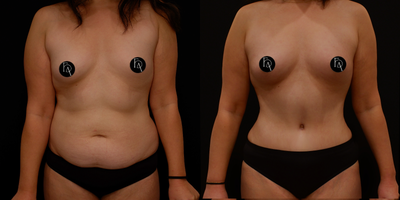 35-44 year old woman treated with Tummy Tuck, Power-Assisted Liposuction (PAL), Abdominal Etching, Breast Fat Transfer - Before: Notice the initial lack of abdominal definition and the desire for a fuller, more balanced breast profile without the use of traditional implants.After: The transformation is striking - a sculpted, toned abdomen with artfully contoured lines thanks to the liposculpting technique. Simultaneously, the breast fat grafting provides a subtle, natural enhancement, harmonizing the patients silhouette without compromising her natural aesthetics.This comprehensive approach highlights our commitment to creating individualized, flattering outcomes that respect each patients unique body shape and aesthetic goals. Witness the empowering journey of body confidence, where strategic contouring and natural augmentation converge.