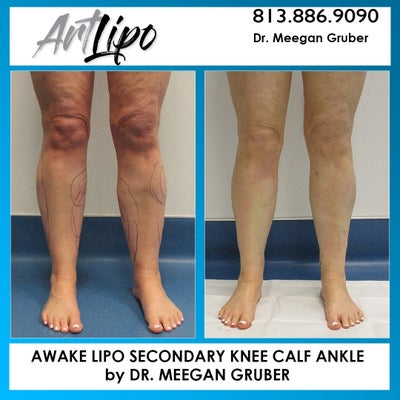 Calf and Ankle Liposuction - Meegan Gruber, MD - Review - RealSelf