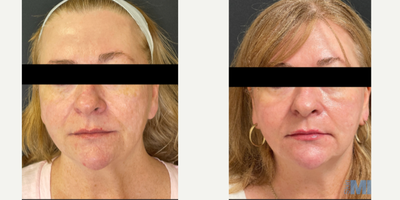 45-54 year old woman treated with NeoGen Plasma - This patient received 1 NeoGen low energy treatment. She is very happy with the improved texture and tone of her skin. Reduced pigmentation is also to be noted!