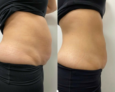 35-44 year old woman treated with truBody - Destroy fat cells through radio frequency, heated lipolysis. Permanent. Warming sensation. Combine with multidirectional muscle stimulation for 34% increase in muscle mass.