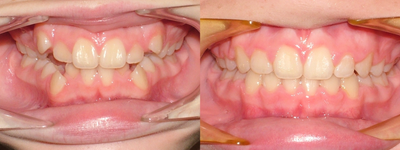 Dental crowding and arch constriction, Damon Treatment - 
	Early teenage female treated with the Damon System. Extraction based treatment 22 months of active therapy.
