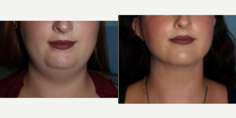 28 Year Old Sun Mental Liposuction Patient - This 28 year old came to us unhappy with the fullness of her neck. After submental liposuciton was performed in the office under local sedation, the patient is very happy with her more refined jaw line and smaller neck.
