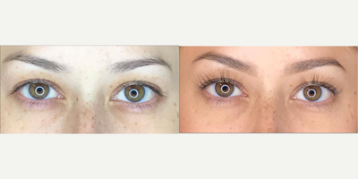 Woman treated with Latisse - Woman treated with Latisse.