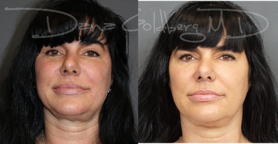 Laser Genesis - Laser Genesis Full Face