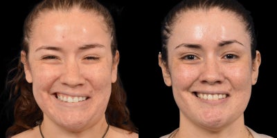 25-34 year old woman treated with Facial Reconstructive Surgery - Before & After: Left Selective Neurolysis & DAO Resection for Facial Synkinesis After Bilateral Bells Palsy
