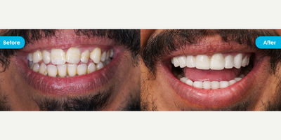 25-34 year old man treated with Dental Crown - Our patient had he received teeth cleaning + 20 crowns