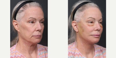 68-70 year old woman treated with Facelift Revision, Neck Lift Revision, Eyelid Surgery Revision, Facial Fat Transfer - Facelift RevisionNeck Lift RevisionLower Blepharoplasty RevisionFacial Fat Transfer