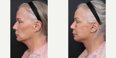 68-70 year old woman treated with Facelift Revision, Neck Lift Revision, Eyelid Surgery Revision, Facial Fat Transfer - Facelift RevisionNeck Lift RevisionLower Blepharoplasty RevisionFacial Fat Transfer