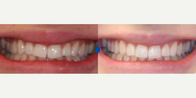 Woman treated with Invisalign, Smile Makeover - Patient presented with a chief complaint of his upper front tooth sticking out. Invisalign treatment took just months to complete followed by Zoom! white speed in-office whitening to give a brighter smile.