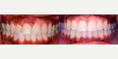 Man treated with Invisalign - Patient presented with a chief complaint of uneven teeth and poor midline due to relapse after wisdom teeth eruption. Invisalign treatment was completed in 7 months using the accelerated Propel technique.