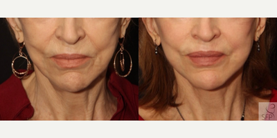 75 year old woman treated with Bellafill - 75 year old woman treated with Bellafill for added volume as well as Deep Plane Facelift to address skin laxity, shown 5 months post op.