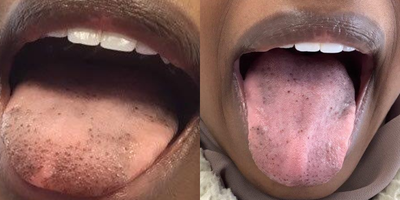 25-34 year old woman treated with Laser Peel - 25 YO treated with one ruby laser for tongue pigment