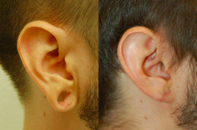 18-24 year old man treated with Ear Lobe Surgery - This gentleman, in his early 20s, needed an earlobe repair. This was performed in the office, under local anesthesia. He was pain free during the procedure. These postoperative pictures are taken at only 3 weeks. His scar will fade over the next several weeks.