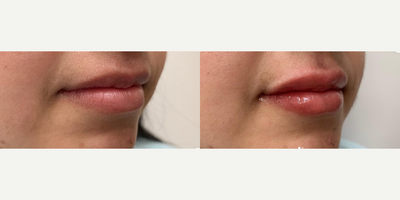 Woman treated with Juvederm - Woman treated with Juvederm