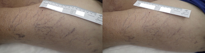 65-74 year old woman treated with Asclera - Photos are after a single treatment with Asclera to the patient's thigh