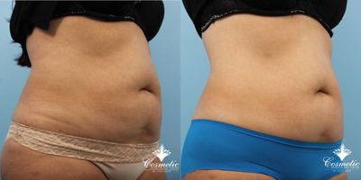 Woman treated with Emtone - Woman treated with 4 treatments ofEmtone and Emsculpt for smoother abdomen