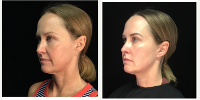 35-44 year old woman treated with Nonsurgical Facelift - This patient received 6 Evoke by InMode treatments to her lower face and chin/jowl area. She hadthe lifting, tightening and overall improvement of her lower face and jowl area.
