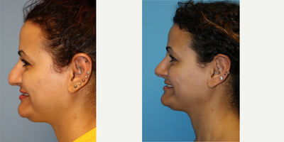 25-34 year old woman treated with Rhinoplasty - This young woman presented with a crooked, broad nose with a hump and down-pointing tip. She also had difficulty breathing and was on flonase for 5 years prior to her operation. She desired a natural looking nose that did not look overdone. She did not want a scooped out nose and did not want to completely lose her ethnic appearance. She is extremely pleased with her rhinoplasty results. Furthermore, she is off the flonase and is breathing better then ever. Note that even when smiling, her tip remains elevated.