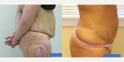 45-54 year old woman treated with Meaningful Beauty, SlimLipo - Tummy Tuck performed only with Local Tumescent Anesthesia allows for a quick recovery with minimal downtime.Bellow you will find a few examples.