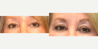 55-64 year old woman treated with Eyelid Surgery - 63 year old female undergoing eyelid surgery.