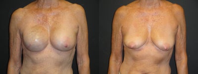 Breast reconstruction - tissue expanders - 
	This is a 63-year-old woman with a history of right breast CA. She was to undergo a right mastectomy and desired breast reconstruction following this procedure. She wished to hopefully improve the shape and increase her size post-reconstrction. She opted for implant-based breast reconstruction on the right along with left implant placement, both using silicone, cohesive gel implants. After photos at 1 year show improved size and shape from preoperative as she wished for.&nbsp;
