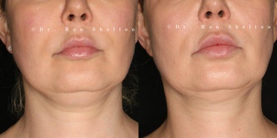 45-54 year old woman treated with Sofwave, Kybella, Neck Lift, Cheek Lift, Nonsurgical Facelift, Skin Tightening, Nonsurgical Ne - 10 Weeks Post Miria Neck, Sofwave Cheeks & 26 Weeks Post KybellaAbove patient received a combination of treatments demonstrating impressive results for non-surgical skin tightening, lifting, and contouring. At 10 weeks post-Miria treatment on the neck, there's a visible improvement in skin firmness, helping to reduce sagging and enhance neck contours. Additionally, Sofwave applied to the cheeks delivers a lifting effect, smoothing and refreshing the mid-face for a naturally rejuvenated look. Kybella treatment treatment resulted in a more defined jawline and reduced submental fullness, as Kybella targets and dissolves excess fat under the chin. Together, these treatments worked synergistically, using advanced technology to achieve a lifted, sculpted, and refreshed appearance without the need for surgery.
