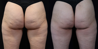 45-54 year old woman treated with Acoustic Wave Therapy, Emsculpt - EmsculptNeo Treatments and Resonic (acoustic wave therapy) to reduce cellulite.