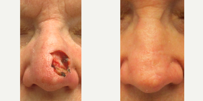 55-64 year old woman treated with Mohs Surgery, Skin Rejuvenation - 59-year-old female before and 10 months after removal of left nasal SCC (squamous cell carcinoma) with Mohs followed the next day by Full thickness, skin graft reconstruction. Patient then started using Dr. Sperons Natural Skin Care Natural Scar Support Treatment after the 2 week check up. She is cancer free and happy with the cosmetic results.