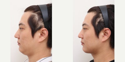 25-34 year old man treated with AccuLift, Laser Liposuction - 29 Years old male patient Chief Complain: double chinTreatment Plan:   double chin liposuction and chin muscle liftOutcome:  - double chin liposuction pure fat : 25cc- lifted jaw line reached by chin muscle lift