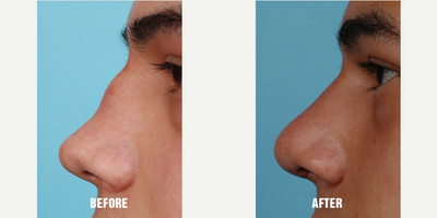 18-24 year old man treated with Revision Rhinoplasty - This patient presented after a devastating injury where he lost most of the cartilage in his septum. He complained of severe breathing difficulties through both his nostrils with the inability to breathe from either side of his nose. He also was very concerned from the collapsed appearance of his nose. He was found to have lost most of his cartilage from his septum from a complication stemming from his injury. A small strip of cartilage from his rib was used to reconstruct his nose and correct his breathing problem.