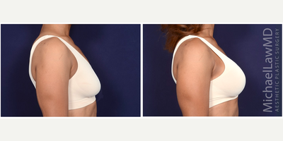 35-44 year old woman treated with Sientra Breast Implants - Breast augmentation. Follow-up photos taken 1 month after the procedure.