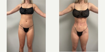 Woman treated with Rib Remodeling - Woman treated with Rib Remodeling