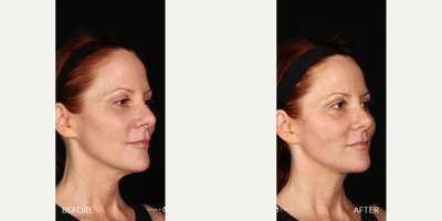 35-44 year old woman treated with Miracu - Our patient came to us after noticing some laxity in her face and wanted to treat her concerns with a noninvasive treatment. She has been worried about the laxity her skin has on her face after she accomplished a dramatic weight loss. She is happy she lost so much weight but it has caused her lower face and neck to drop. She was able to undergo a quick office treatment which left her with results that would last for a whole yearNo treatment is complete without EMER SKIN. Using our products post-treatment will enhance results to the absolute maximum. Click Link in Bio Click Emer Skin